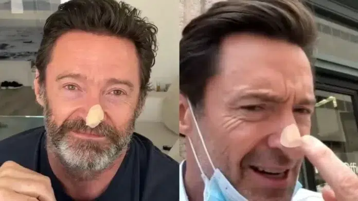 Hugh Jackman's Skin Cancer Scare: Early Warning Signs, Prevention, and Treatment