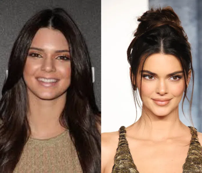 Did Kendall Jenner Get Plastic Surgery? Fans Compare Early Photos