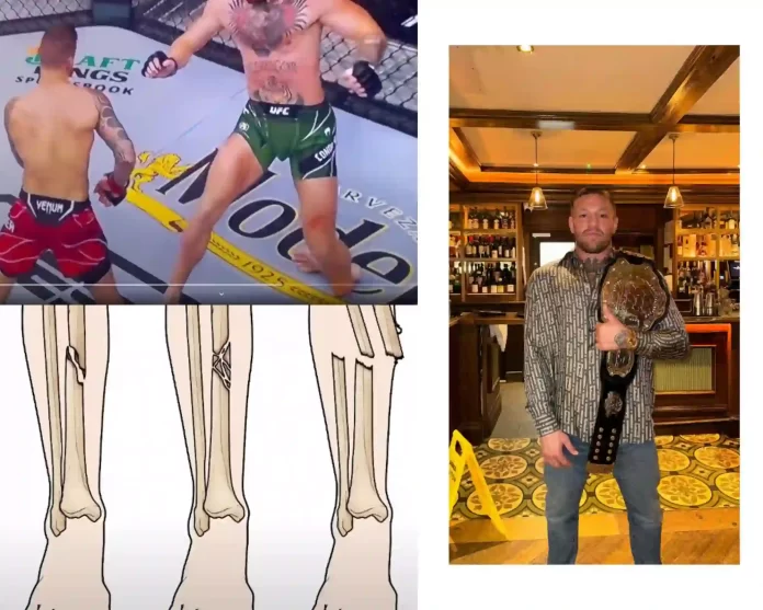 Connor McGregor leg injury fight