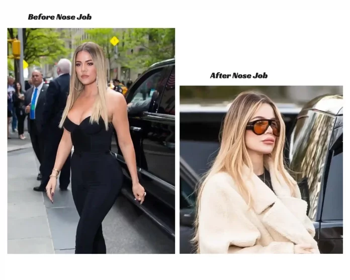 khloe kardashian nose