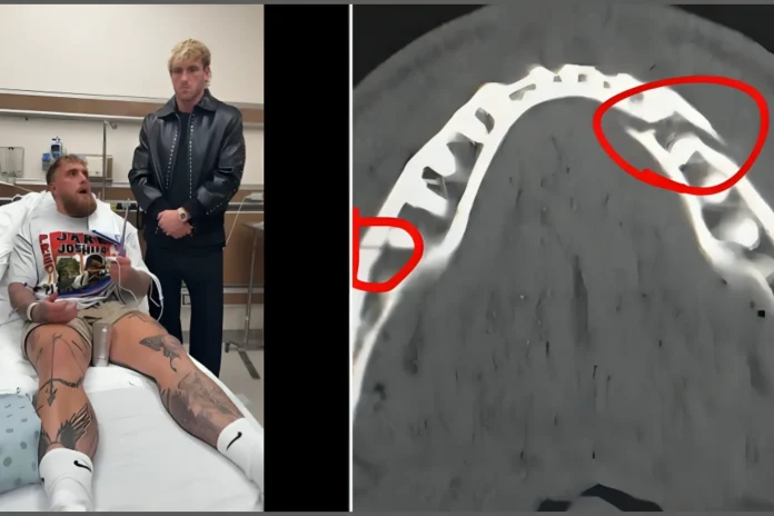 Jake Paul broken jaw