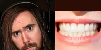 Asmongold Spends $7K on Dental Work After Twitch Ban: “Rotting” Teeth Fixed Asmongold teeth fix