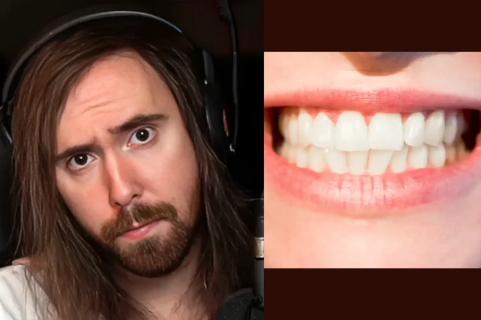Asmongold teeth fix